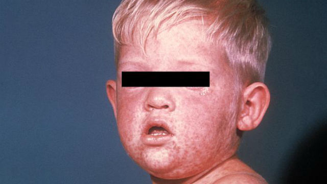Boy with measles